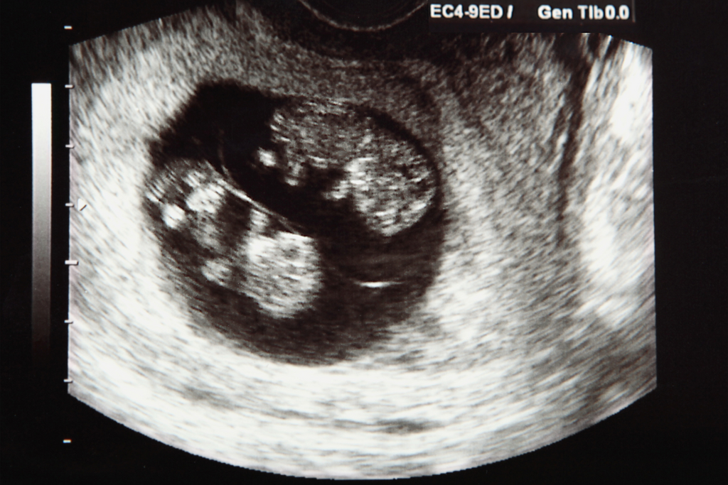 Twin Pregnancy - A birth story from a mum of twins